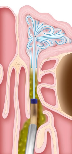 Dr. Steven Kin: Center For Ear, Nose, & Throat PC at 2300 Haggerty Rd Ste 2130